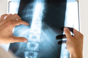 What’s the Average Settlement for a Spinal Injury?
